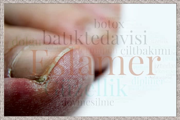 Mantar Tırnak Tedavisi